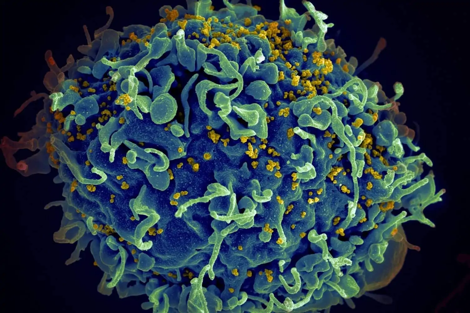 Moderna has begun testing the HIV vaccine using mRNA technology