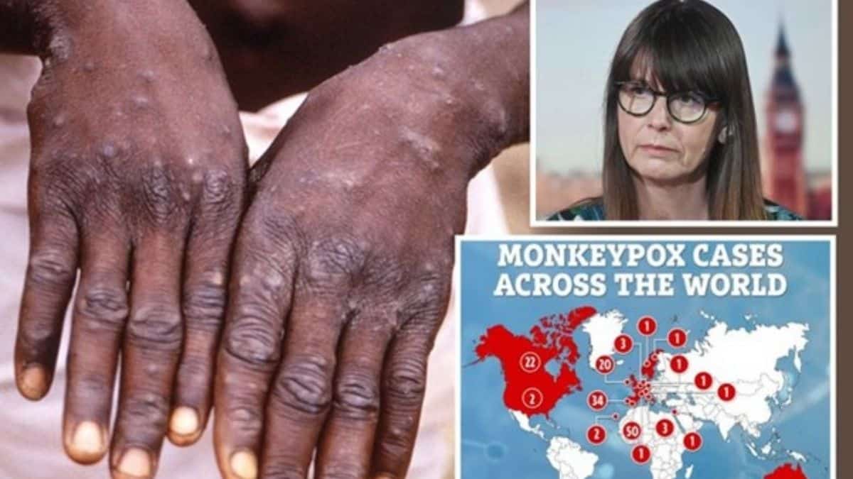 SA unlikely to impose harsh lockdown over monkeypox outbreak